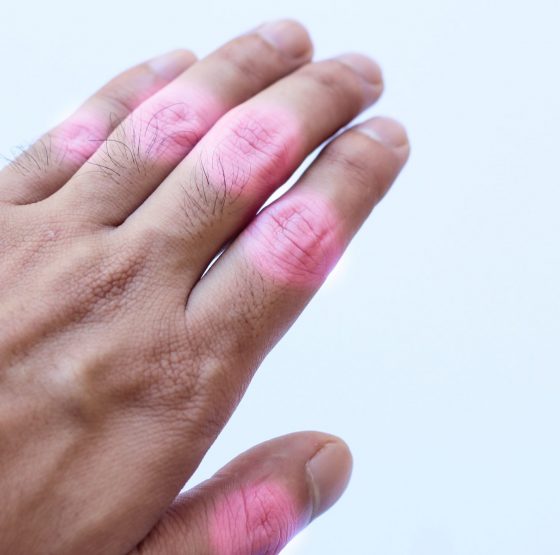 Arthritis in den Fingergelenken