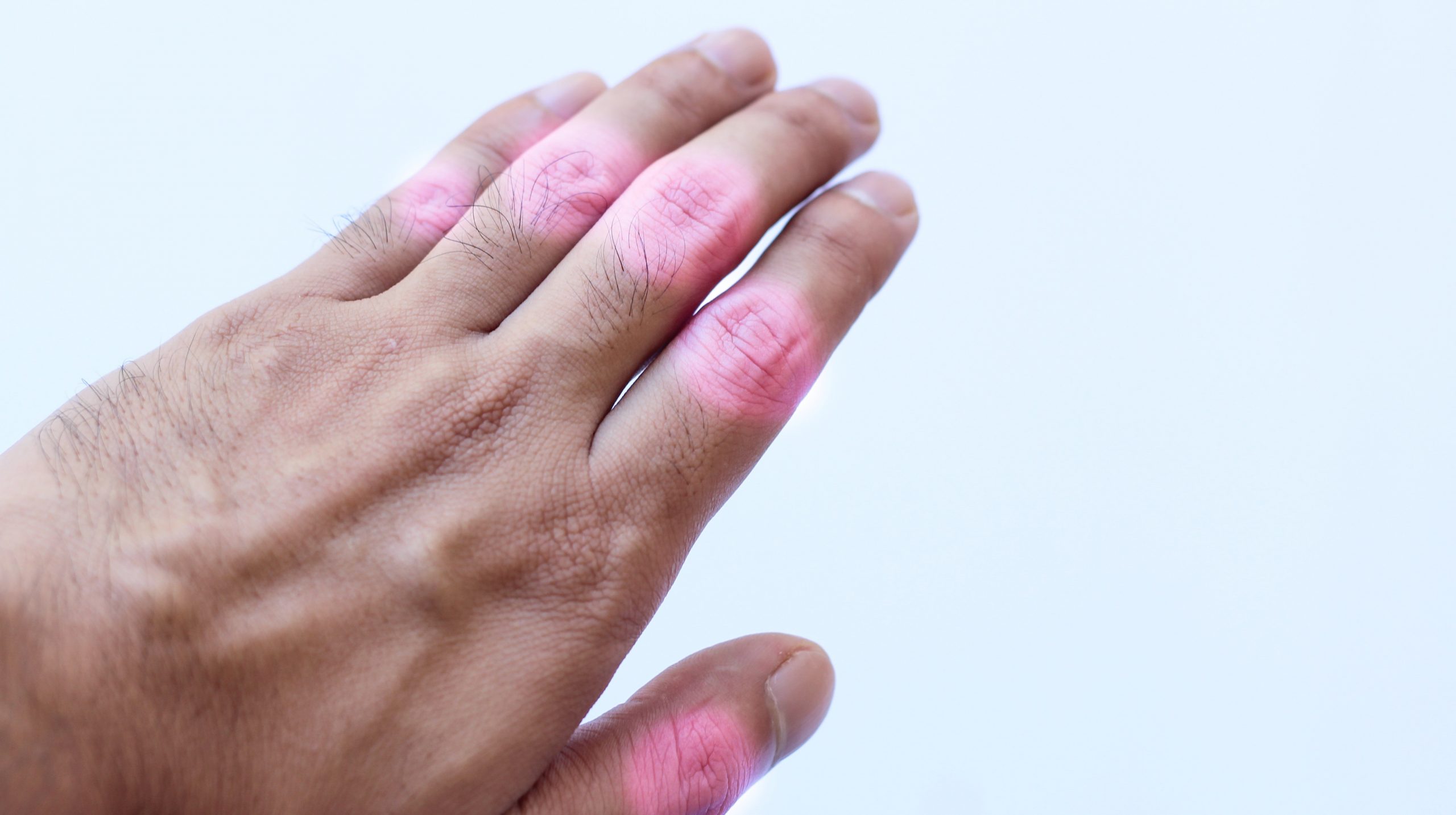 Arthritis in den Fingergelenken