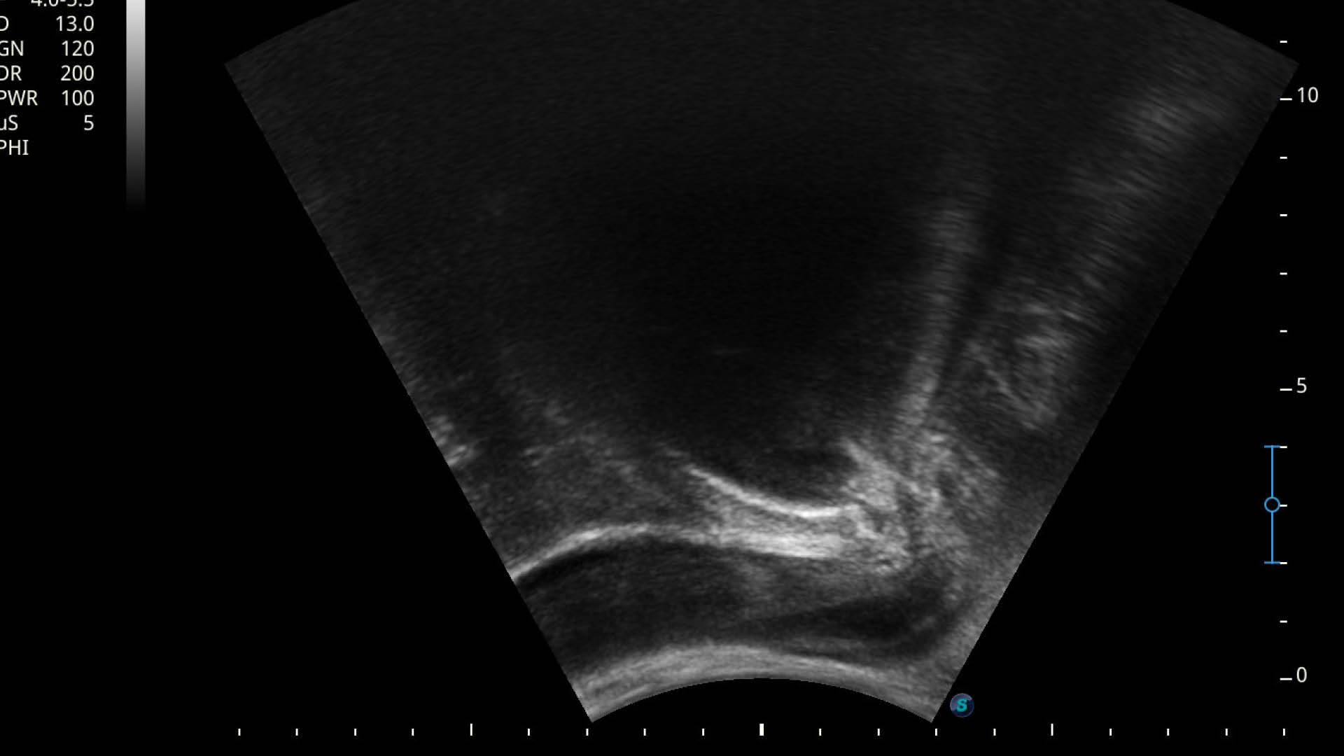 Neutral_Physiotherapie_Beckenboden Mann Ultraschallbild angespannt_praxis entero Ultraschallbild der männlichen Blase - praxis entero Graz